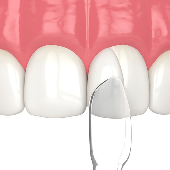 Digital image of cosmetic bonding