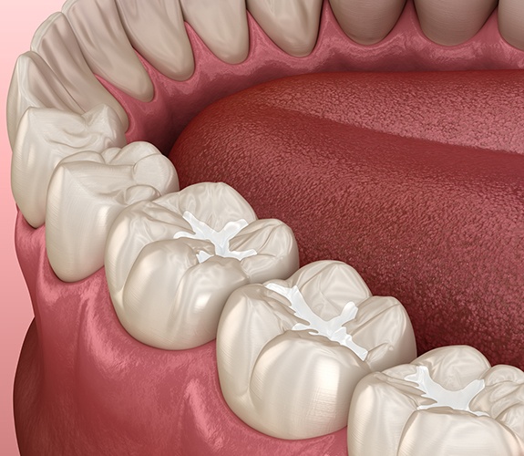 Tooth-colored fillings