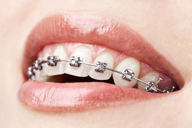 Up-close view of a person with metal braces