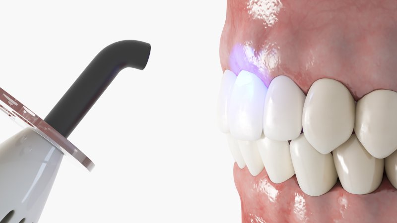 digital image of cosmetic dental bonding