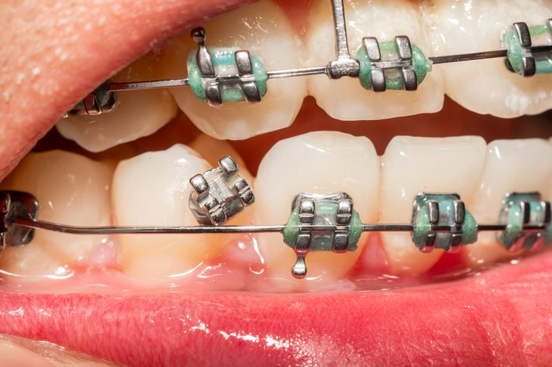 up-close view of broken braces