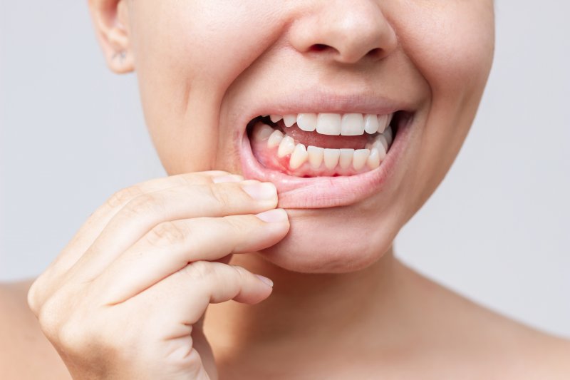 person with a bump on their gums